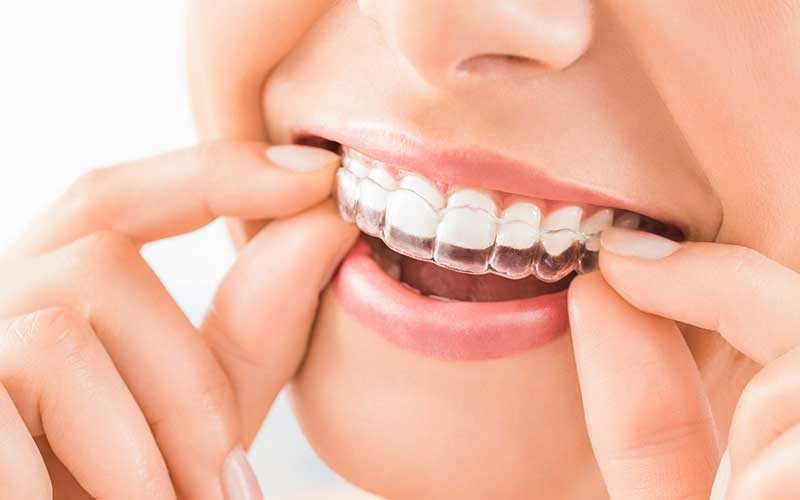 Invisalign in Newmarket